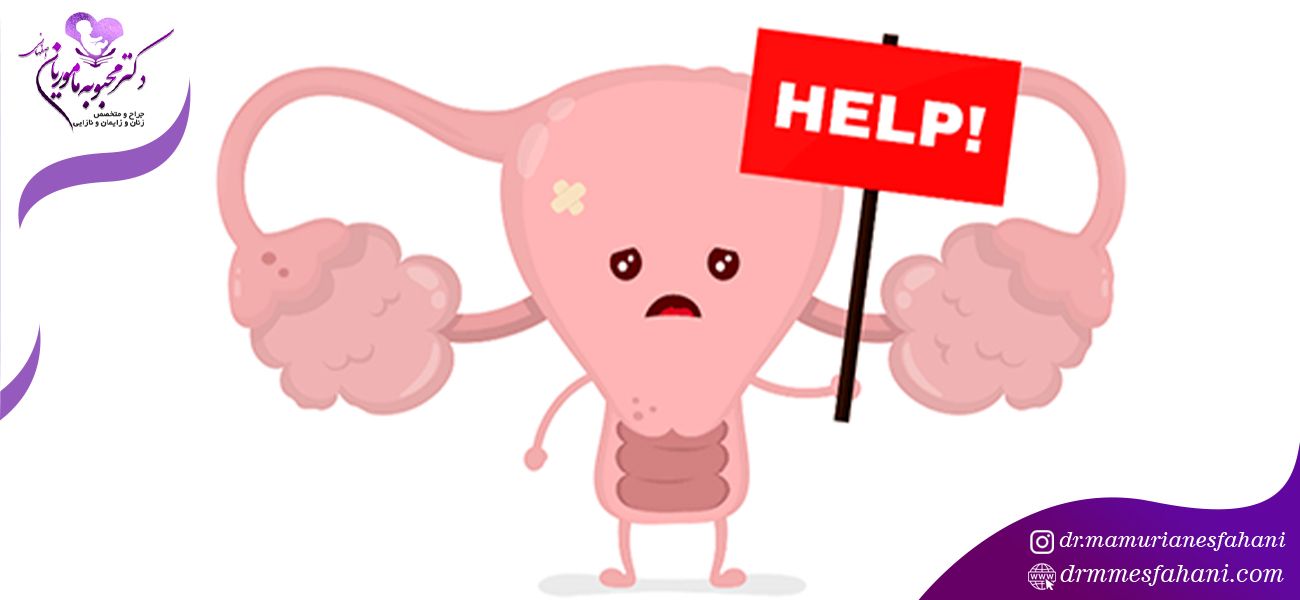 سندرم تخمدان پلی کیستیک چیست؟