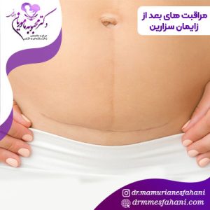 مراقبت های بعد از زایمان سزارین