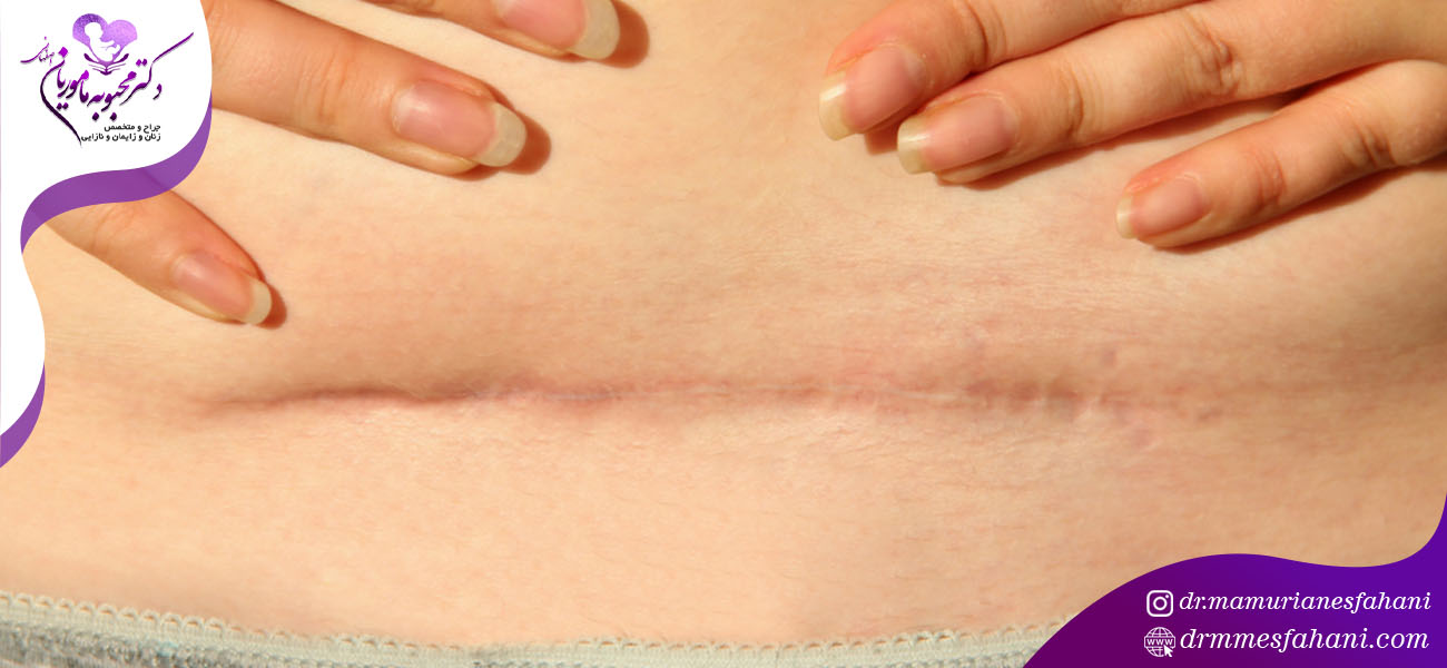 مراقبت های بعد از زایمان سزارین