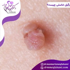 زگیل تناسلی چیست و چگونه شکل می گیرد؟