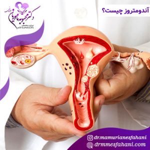 آندومتروز چیست؟