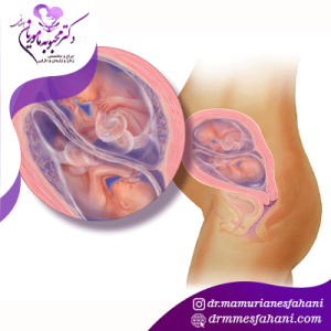 دوقلو باردار شدن