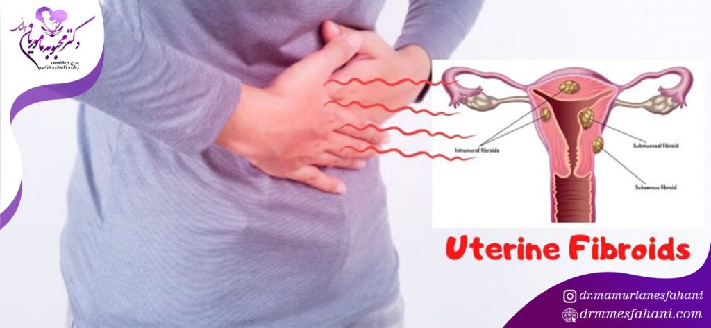 فیبروم رحم