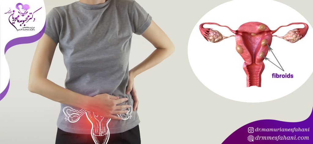 فیبروم رحم