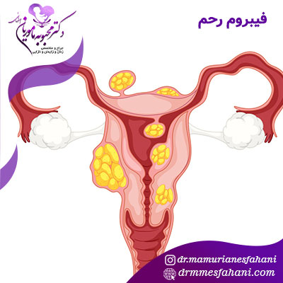 فیبروم رحم