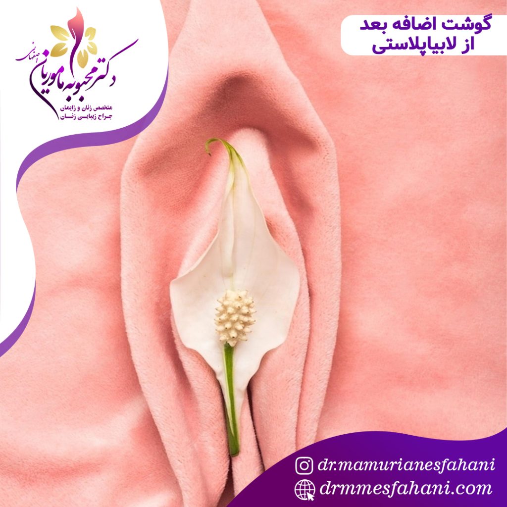 گوشت اضافه بعد از لابیاپلاستی