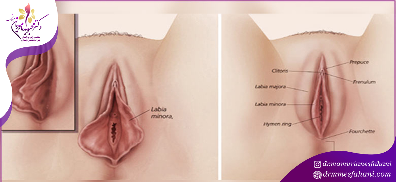 محدودیت های سنی برای انجام جراحی لابیاپلاستی