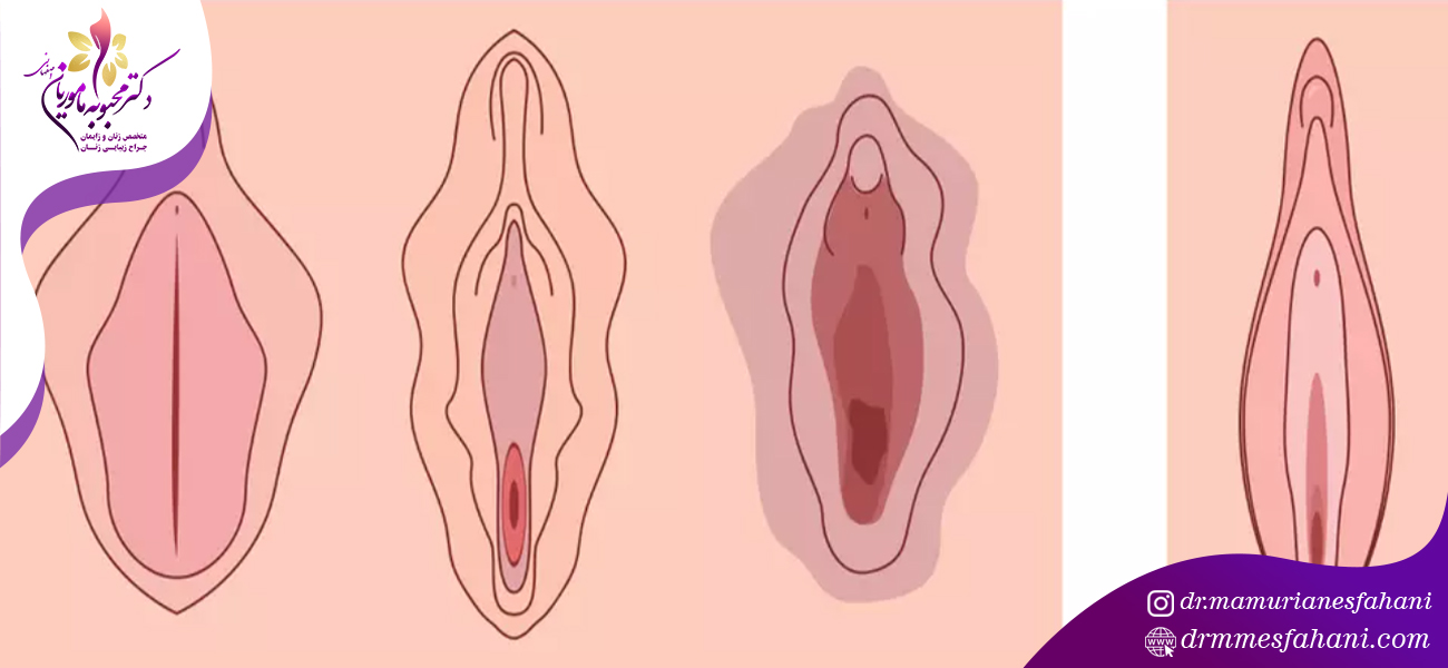 سن مناسب برای انجام لابیاپلاستی