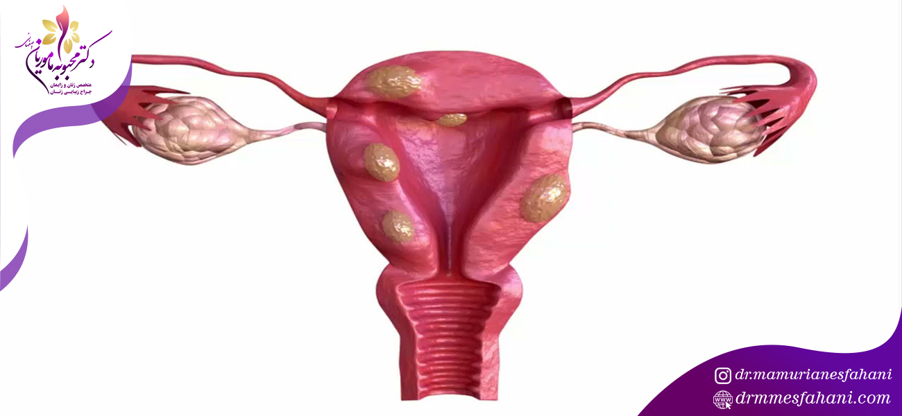 آندومتریوز در دختران