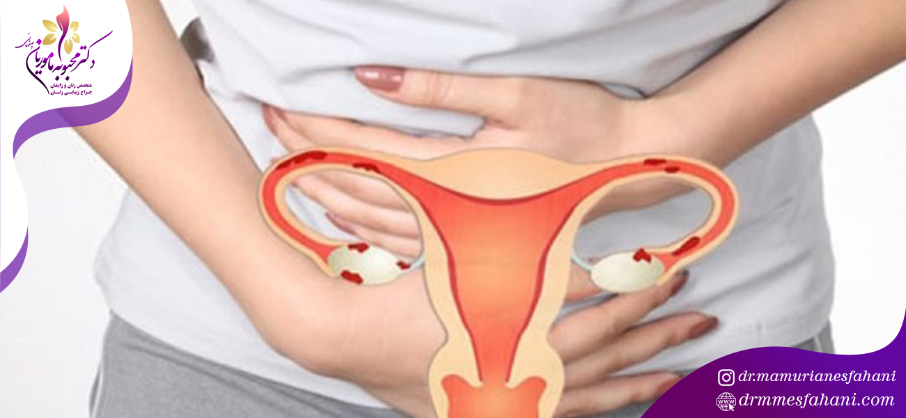آیا آندومتریوز باعث نازایی می شود؟