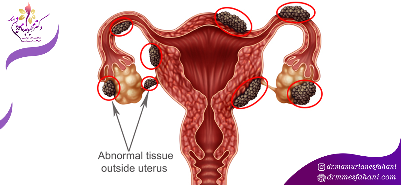 مهم ترین علائم اندومتریوز چیست؟