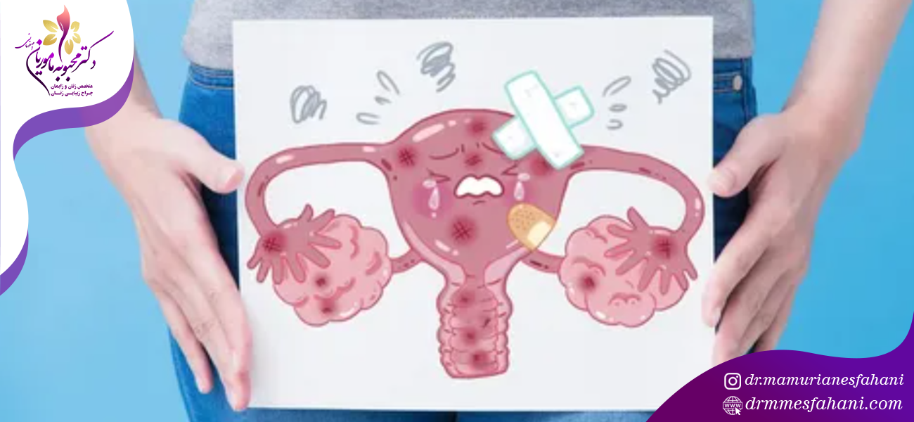 درمان آندومتریوز