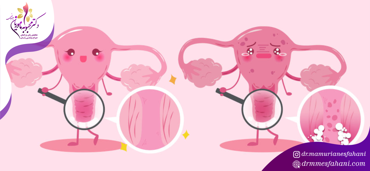 امکان بروز عفونت واژن بدون داشتن رابطه جنسی وجود دارد؟