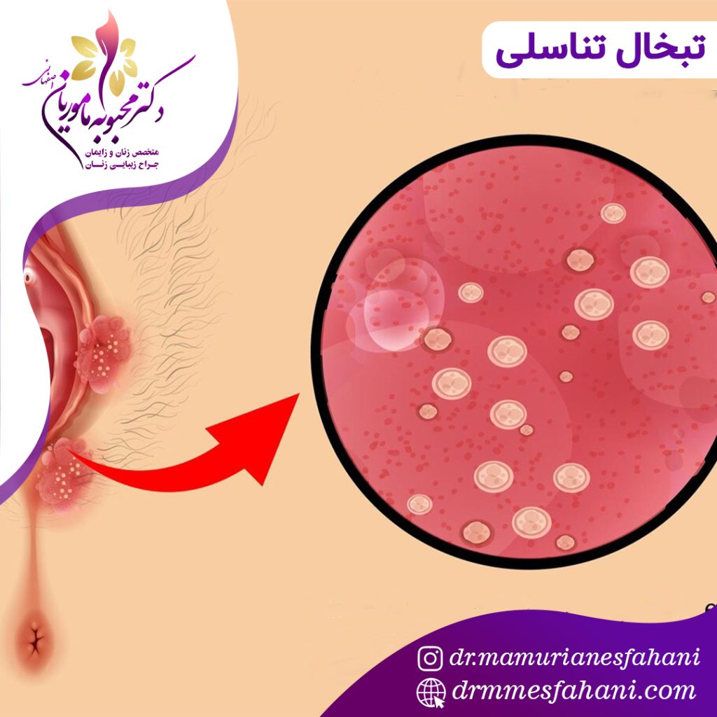 پیشگیری از ابتلا به تبخال تناسلی