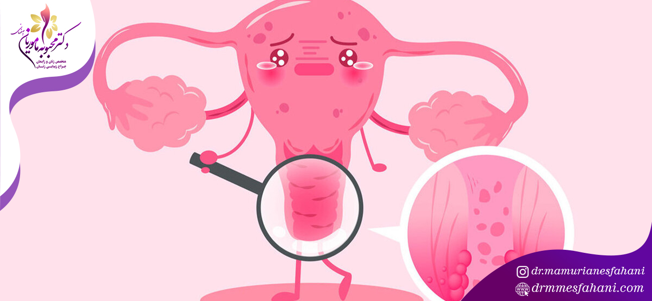 انواع عفونت واژن