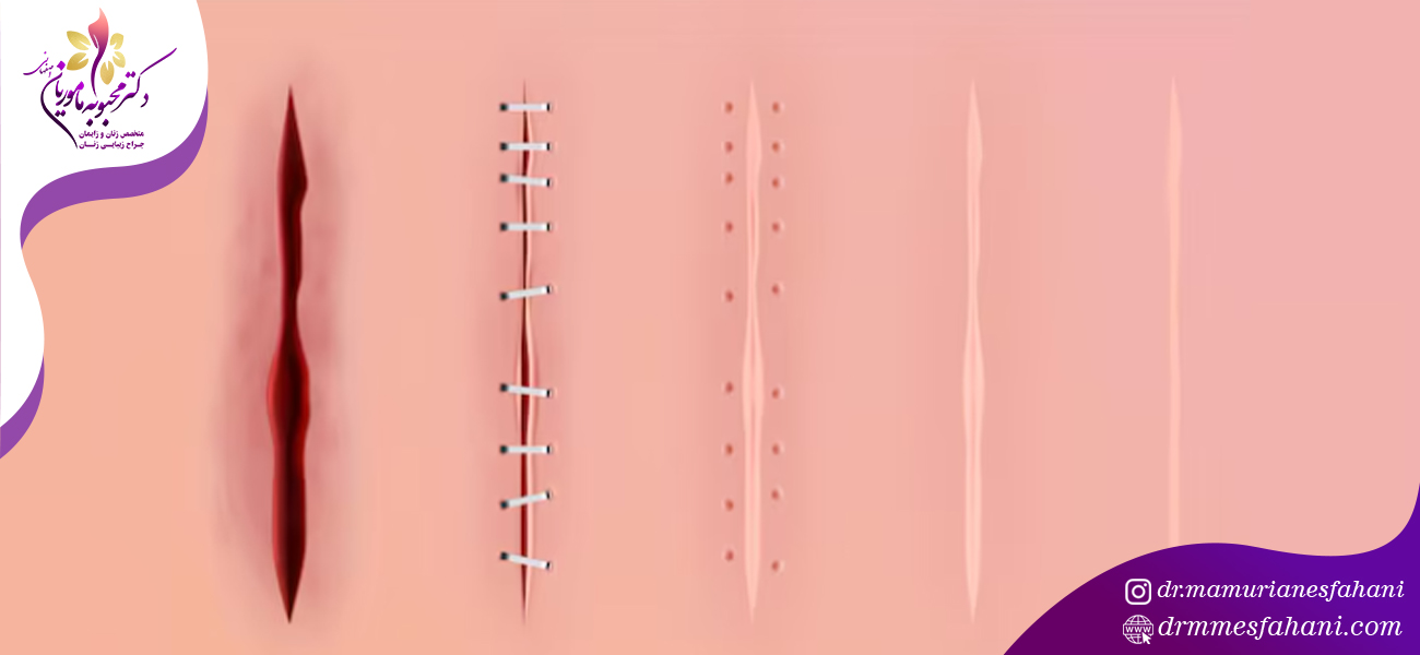 نکات مراقبتی جهت پیشگیری از ایجاد جای بخیه زایمان سزارین