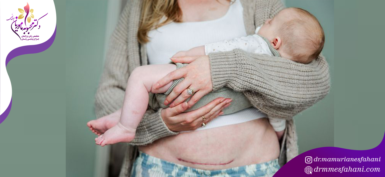 راه هایی برای از بین بردن جای زخم سزارین