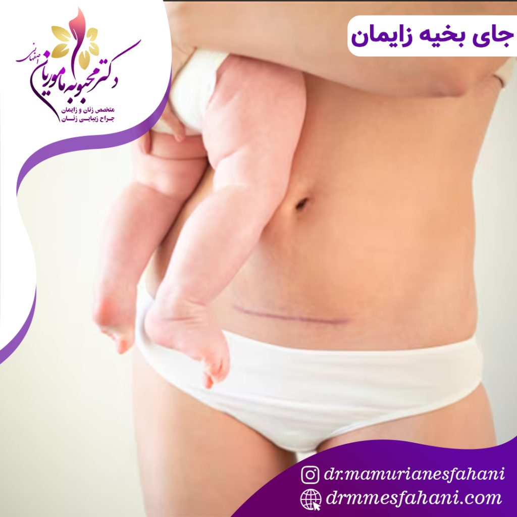 جای بخیه زایمان سزارین