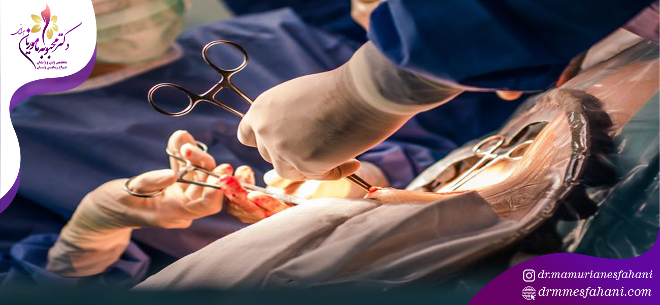 زایمان سزارین چقدر طول می کشد؟