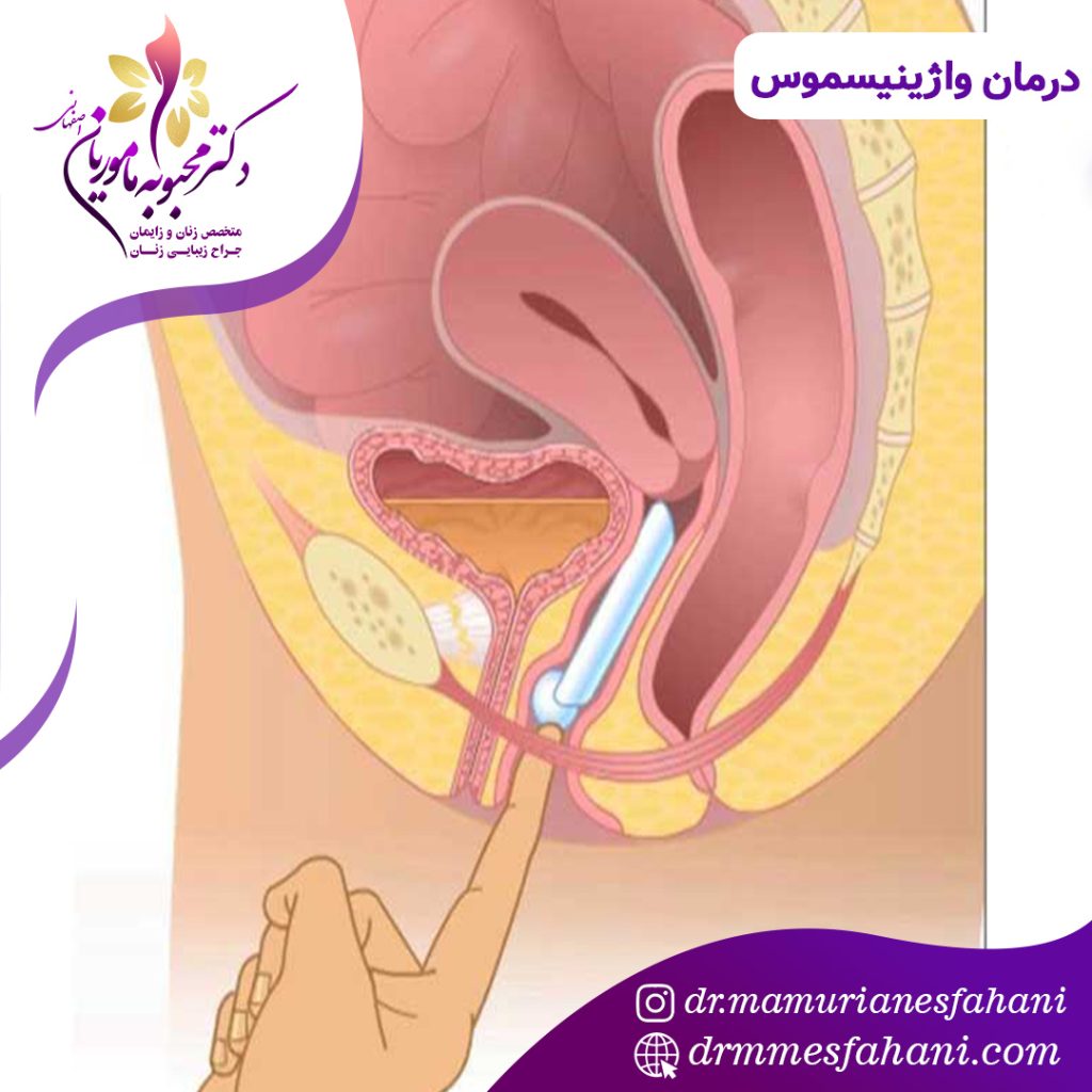 درمان واژینیسموس